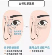 整形美容专家介绍黑眼圈3种类型，医美疗程改善