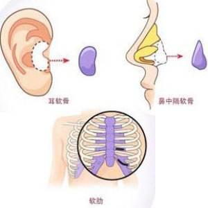 自体软骨隆鼻价格