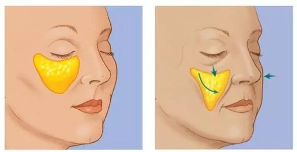 面部脂肪填充的五大要点