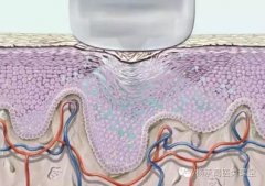激光除皱具体注意事项