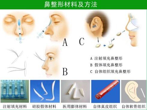 自体软骨隆鼻可以选用什么材料