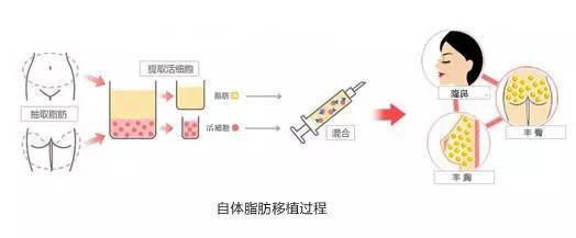 自体脂肪隆鼻需要注意什么