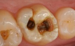 补牙材料用什么样的好，会不会对身体有害？