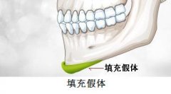 膨体隆下巴的危害有哪些