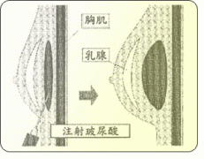 注射丰胸有什么优势