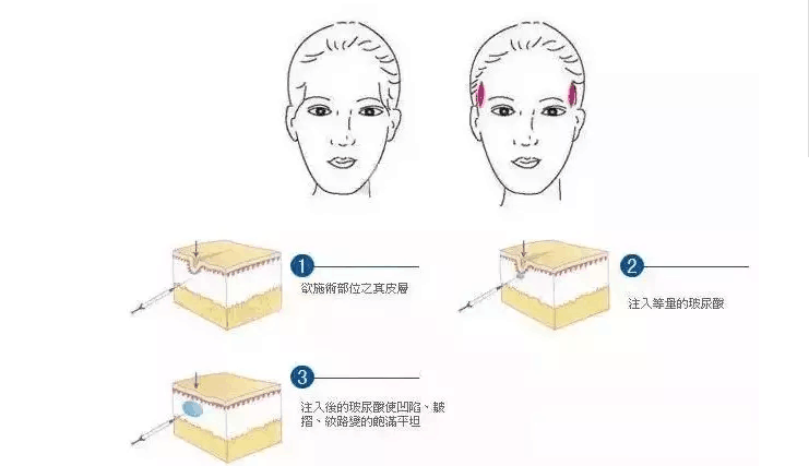 玻尿酸丰太阳穴的效果