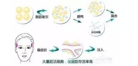 玻尿酸丰太阳穴手术