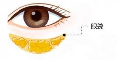吸脂祛眼袋有没有副作用