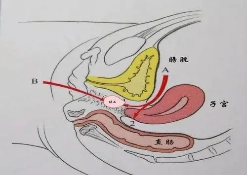 郑州治疗阴道闭锁